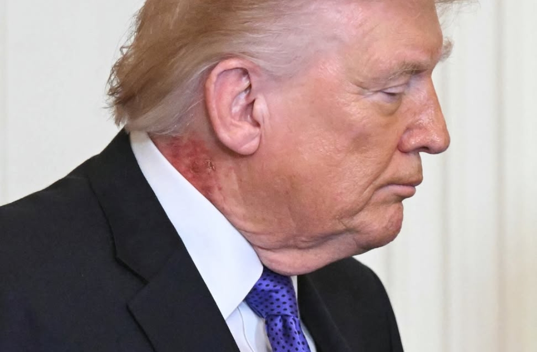 White House Doctor breaks silence on the new noticeable rotting rash-like mark on Trump's neck during an event in newly released photo, exposing the reason for the bruising on his hands, swollen ankles and rashes on his neck… it’s getting bad!